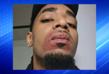 Solo Kutz Speaks Out After Noticing Pimples on Lips Following Recent Encounter