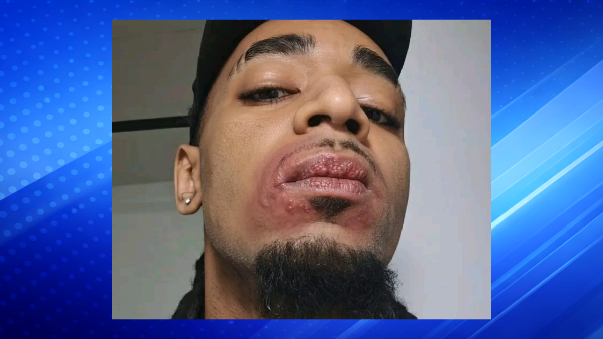Solo Kutz Speaks Out After Noticing Pimples on Lips Following Recent Encounter